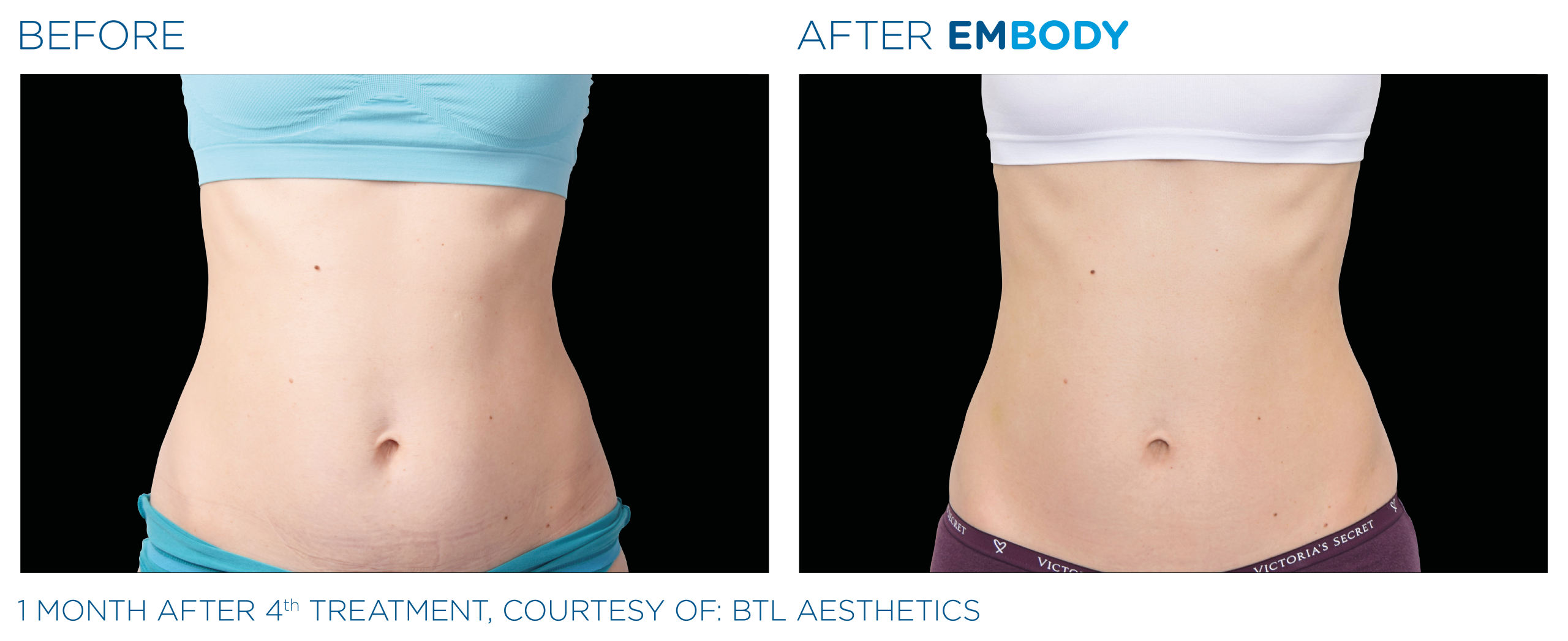 EMBODY® 核心美力 改善腹部術前術後對比